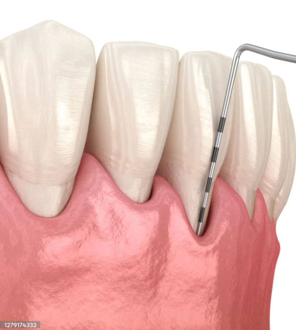 Tratamiento periodontal en DDS Odontología